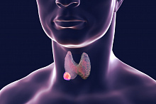 Активное наблюдение или хирургическое лечение: что выбирают врачи при папиллярной микрокарциноме щитовидной железы