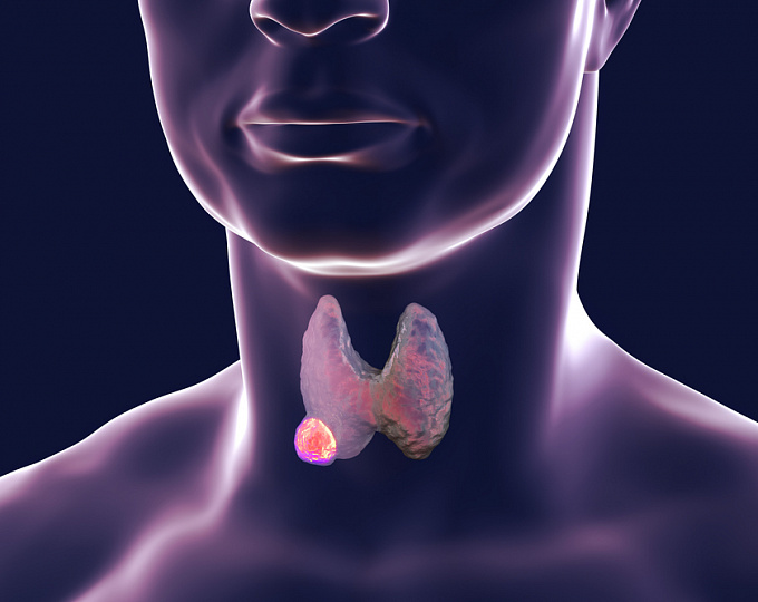 Активное наблюдение или хирургическое лечение: что выбирают врачи при папиллярной микрокарциноме щитовидной железы