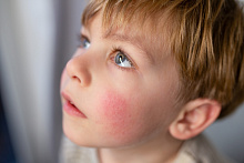 Связь между активностью атопического дерматита и риском сердечно-сосудистых заболеваний у детей и подростков