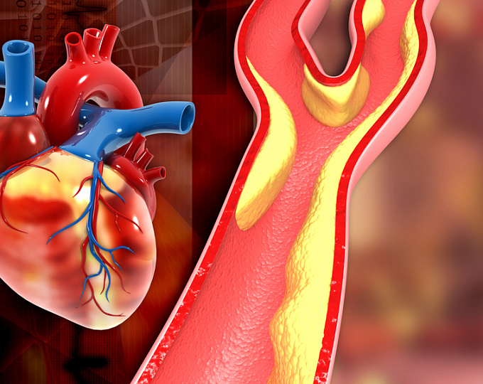 Высокий риск смертности при стенозе аорты: как определить?