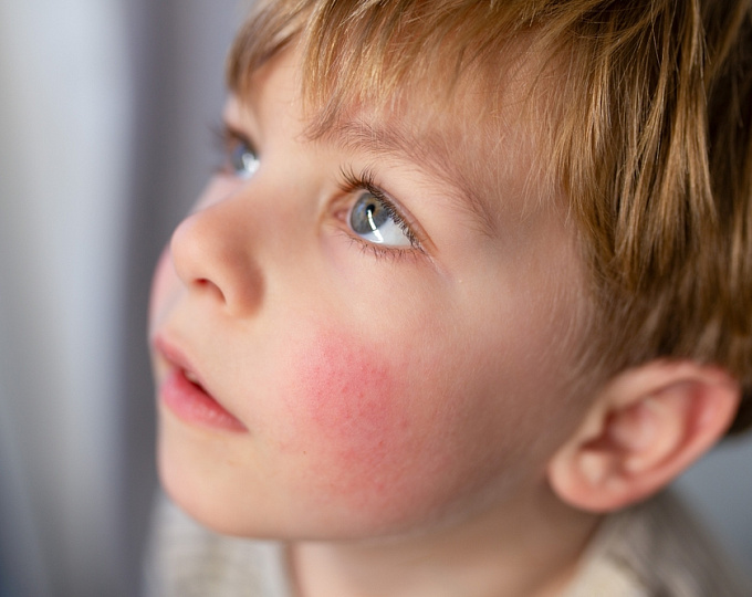 Связь между активностью атопического дерматита и риском сердечно-сосудистых заболеваний у детей и подростков