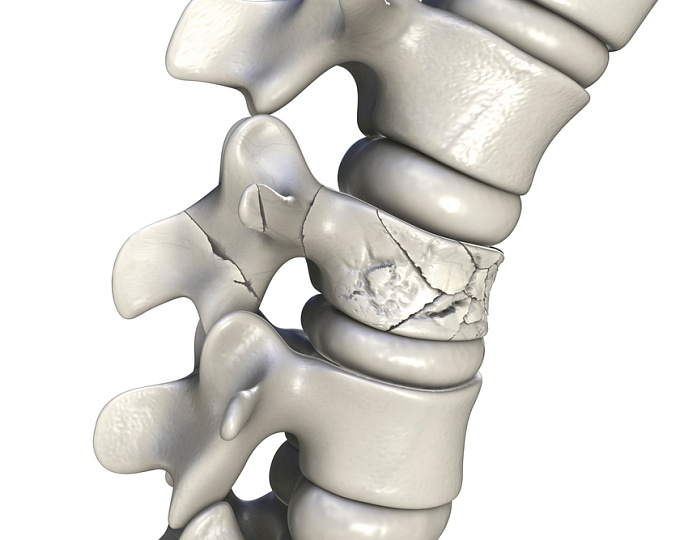 Витамин D и кальций в снижении риска переломов: обобщенные данные 