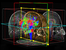О чем могут говорить гиперинтенсивные очаги в белом веществе головного мозга у психиатрических пациентов?
