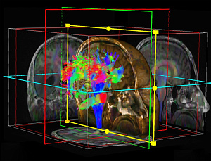 О чем могут говорить гиперинтенсивные очаги в белом веществе головного мозга у психиатрических пациентов?