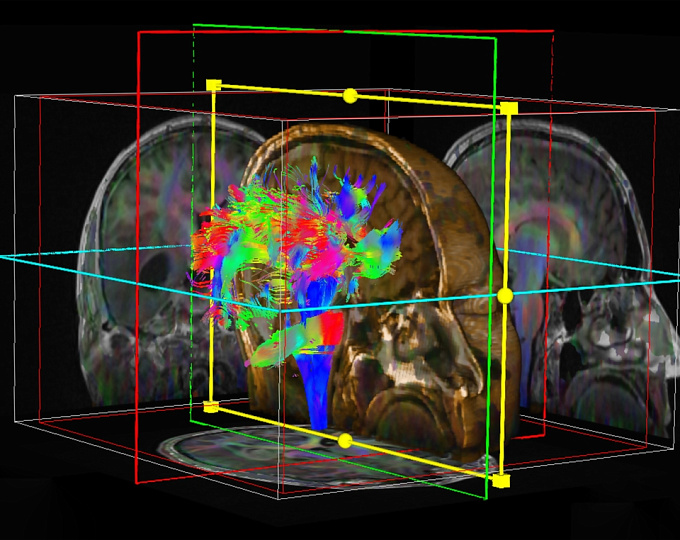 О чем могут говорить гиперинтенсивные очаги в белом веществе головного мозга у психиатрических пациентов?