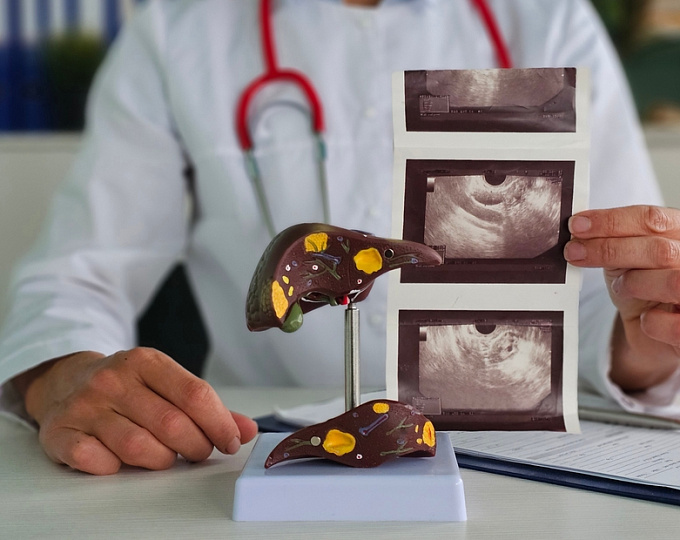 Фиброз печени как фактор риска смертности при сахарное диабете 2 типа