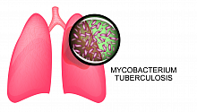 Эффективное лечение резистентного туберкулеза (тройная терапия препаратами бедаквилин, претоманид, линезолид)