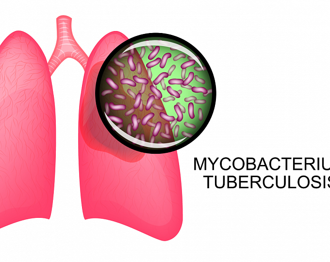 Эффективное лечение резистентного туберкулеза (тройная терапия препаратами бедаквилин, претоманид, линезолид)
