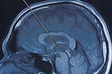 Общая или местная анестезия при глубокой стимуляции головного мозга: что лучше?