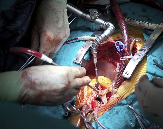 Эффективность левосимендана у пациентов с дисфункцией левого желудочка, перенесших кардиологическую операцию