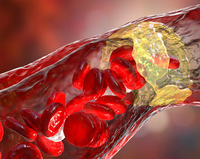 Эффективность статинотерапии в первичной профилактике у пациентов с сахарным диабетом 1 типа 