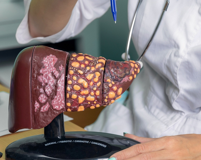 Бремя первичного рака печени метаболической этиологии