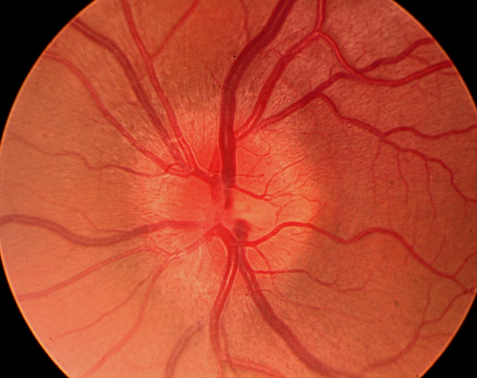 Эффективность опицинумаба у пациентов с острым невритом зрительного нерва 