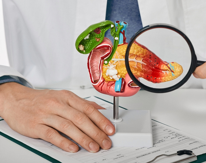 Снижение риска осложнений острого панкреатита у пациентов с СД 2 типа, получающих терапию агонистом рецептора ГЛП-1