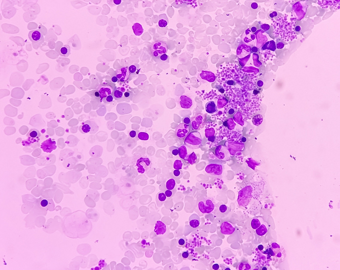 Отдаленные исходы после госпитализации по поводу фибрилляции и трепетания предсердий