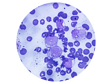 Хроническая лимфоидная лейкемия, продолженная или фиксированная терапия?