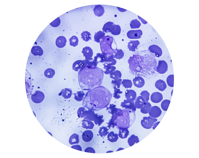 Хроническая лимфоидная лейкемия, продолженная или фиксированная терапия?