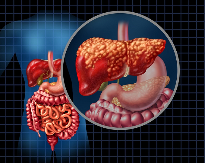 Снижение веса положительно отражается на гистологическом течении МАЖПБ