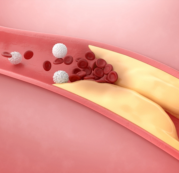 Интенсивное достижение целевого уровня холестерина ЛПНП при атеросклеротических сердечно-сосудистых заболеваниях