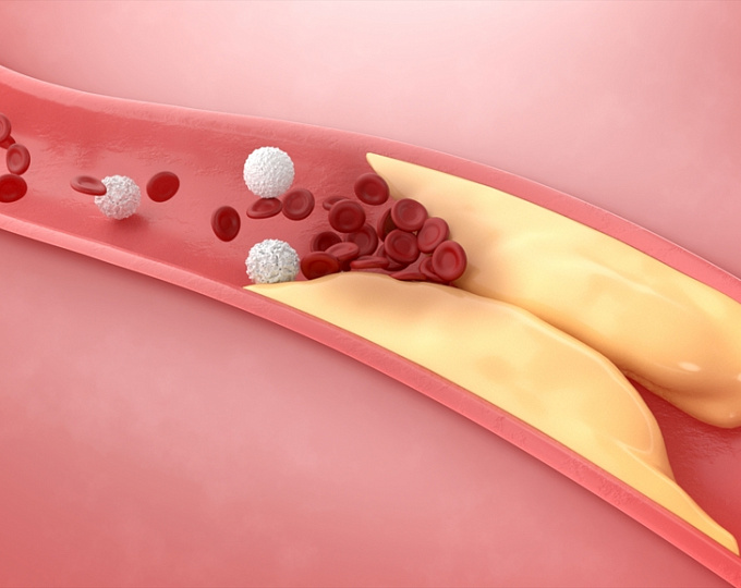 Интенсивное достижение целевого уровня холестерина ЛПНП при атеросклеротических сердечно-сосудистых заболеваниях