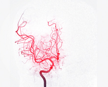 Тревога и депрессия после диагностики аневризмы: влияние на риск разрыва и смертность