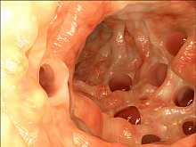 Дивертикулит: новый стандарт лечения?