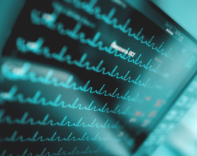 Развитие фибрилляции предсердий у пациентов с сахарным диабетом 2-го типа: влияние на сердечно-сосудистые и почечные исходы