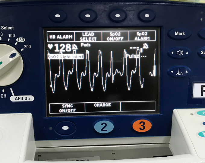 Желудочковая тахикардия у пациентов с дилатационной кардиомиопатией