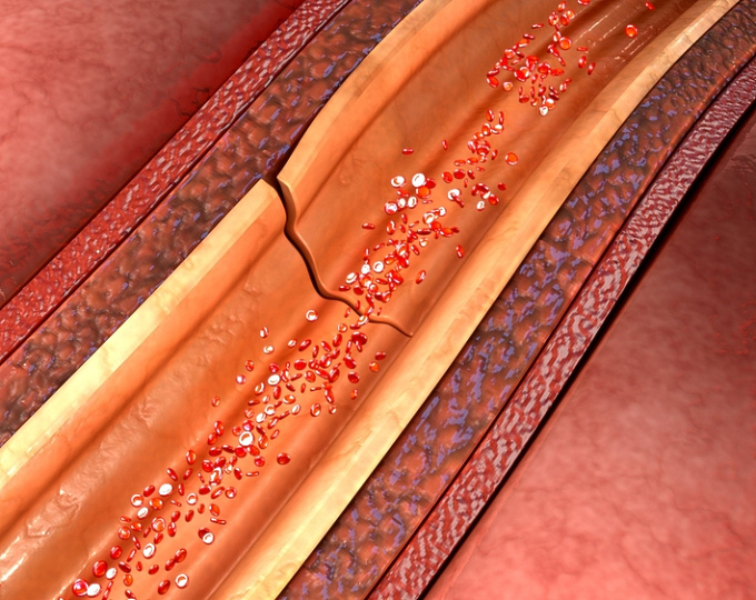 Риск диссекции аорты типа В при синдроме Марфана