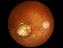 Структурные и сосудистые различия макулярной области в глаукоматозных глазах с и без осевой миопии высокой степени