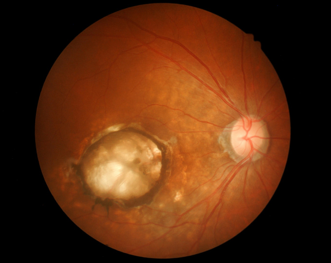 Структурные и сосудистые различия макулярной области в глаукоматозных глазах с и без осевой миопии высокой степени