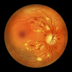 Какова эффективность ранней анти-VEGF терапии при диабетической ретинопатии?