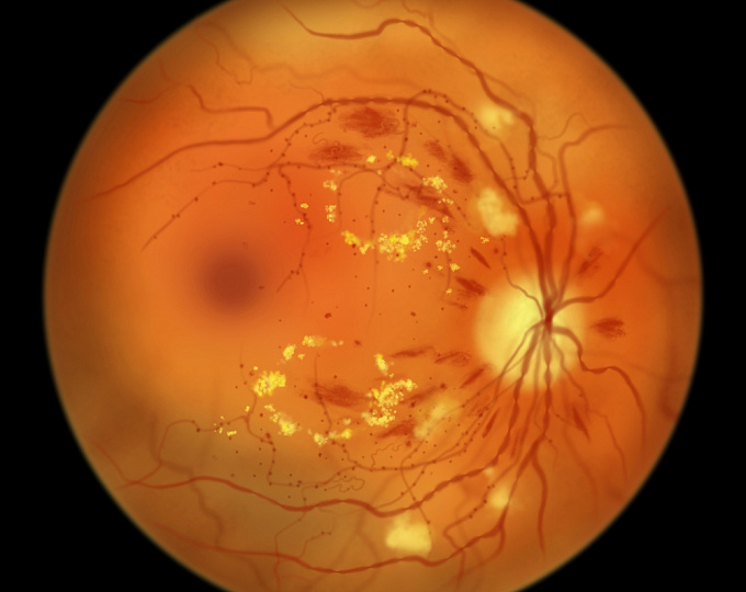 Какова эффективность ранней анти-VEGF терапии при диабетической ретинопатии?