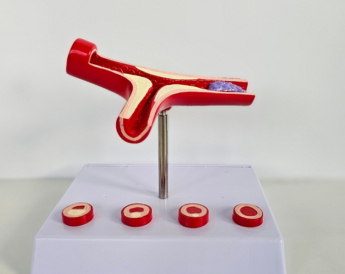 Возраст тромба у пациентов с инсультом