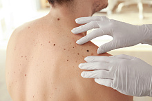 Оправдан ли популяционный скрининг рака кожи?