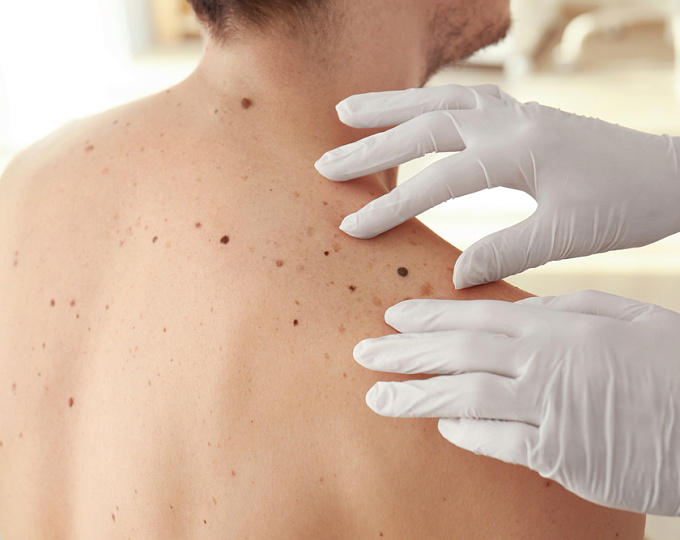 Оправдан ли популяционный скрининг рака кожи?