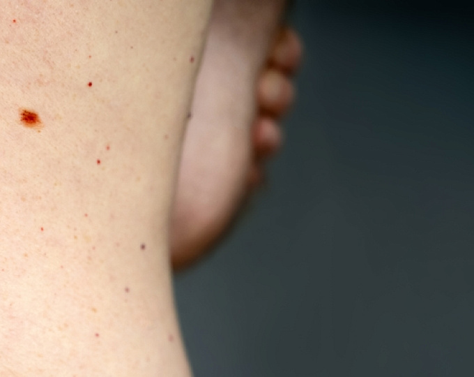 Частота рецидивирования небольших меланом in situ