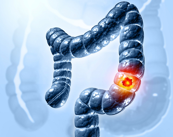 Улучшение выживаемости у пациентов с колоректальным раком на фоне ацетилсалициловой кислоты 