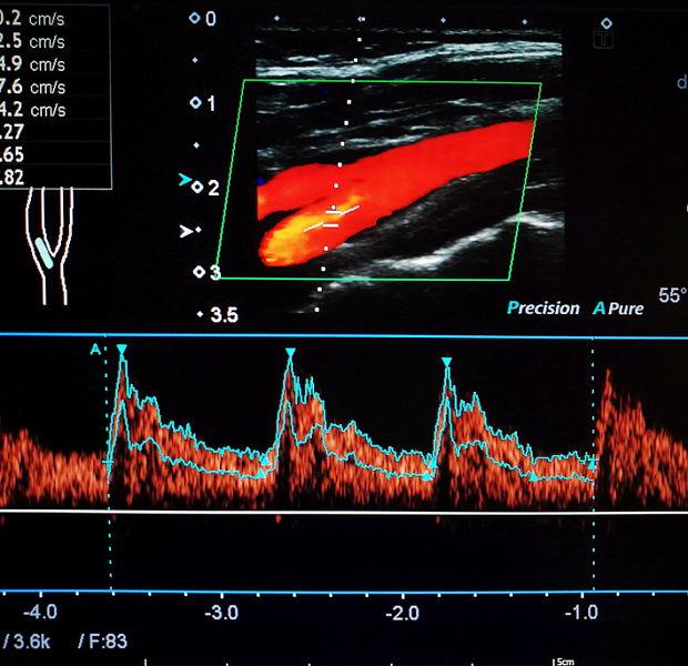 Эффективность реваскуляризации в комбинации с фармакологической терапией у пациентов с асимптомным стенозом сонной артерии 