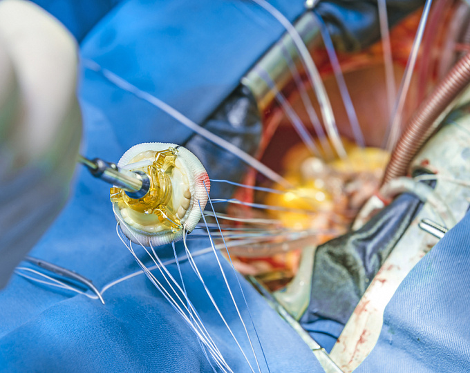 Транскатетерная или хирургическая замена аортального клапана у пациентов с аортальным стенозом?