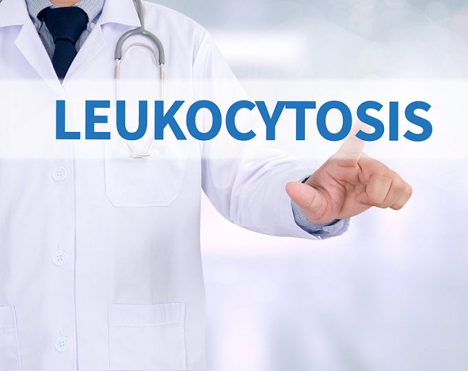 Лейкоцитоз, ассоциированный с терапией глюкокортикостероидами