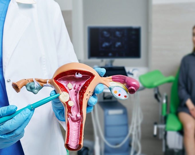 Ожидать ли повышения риска миомы на фоне метаболических изменений?