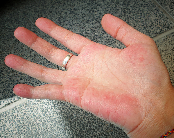 Рецидивирующий перикардит у пациентов с системной красной волчанкой