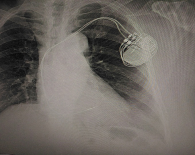 Антибиотикопрофилактика перед имплантацией сердечных электронных устройств 