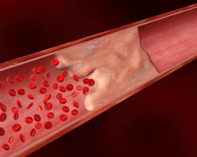 Вклад физической активности в кальциноз коронарных артерий 