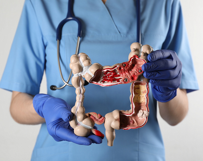 FDA одобрило новый препарат для лечения язвенного колита