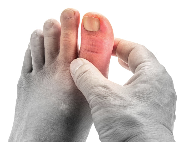 Влияние колхицина на сердечно-сосудистый риск у пациентов с подагрой 