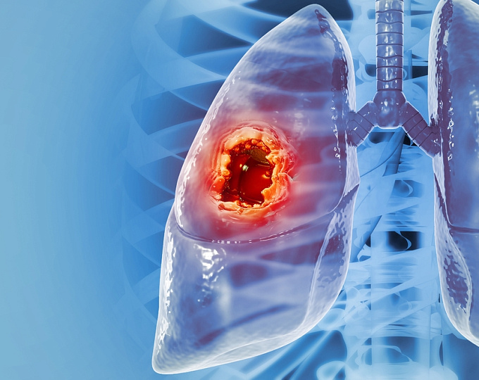 Эффективность ниволумаба в комбинации с химиотерапией в улучшении общей выживаемости при резектабельном немелкоклеточном раке легких