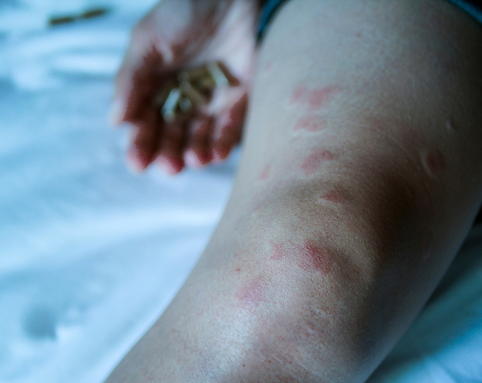 Механизм действия барицитиниба и идентификация биомаркеров и ключевых иммунных путей у пациентов с активной системной красной волчанкой