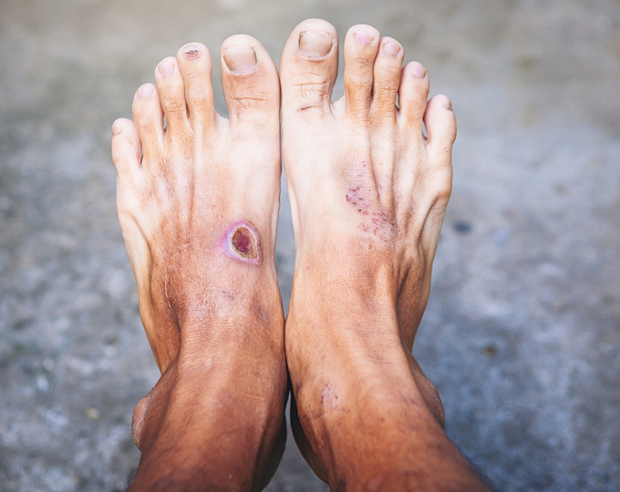 Безопасность ингибиторов SGLT2 при диабетической стопе: данные ретроспективного исследования